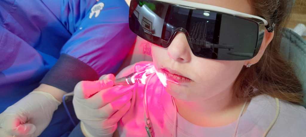 Realizamos tratamientos láser pre y post operatorios, para optimizar analgesia prequirúrgica y acelerar los tiempos de cicatrización post tratamientos; logrando una experiencia odontológica más amena y confortable y una recuperación más rápida, muy recomendada en niños, adolescentes y adultos.